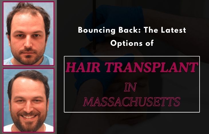 Bouncing-Back-The-Latest-Options-of-Hair-Transplant-in-Massachusetts