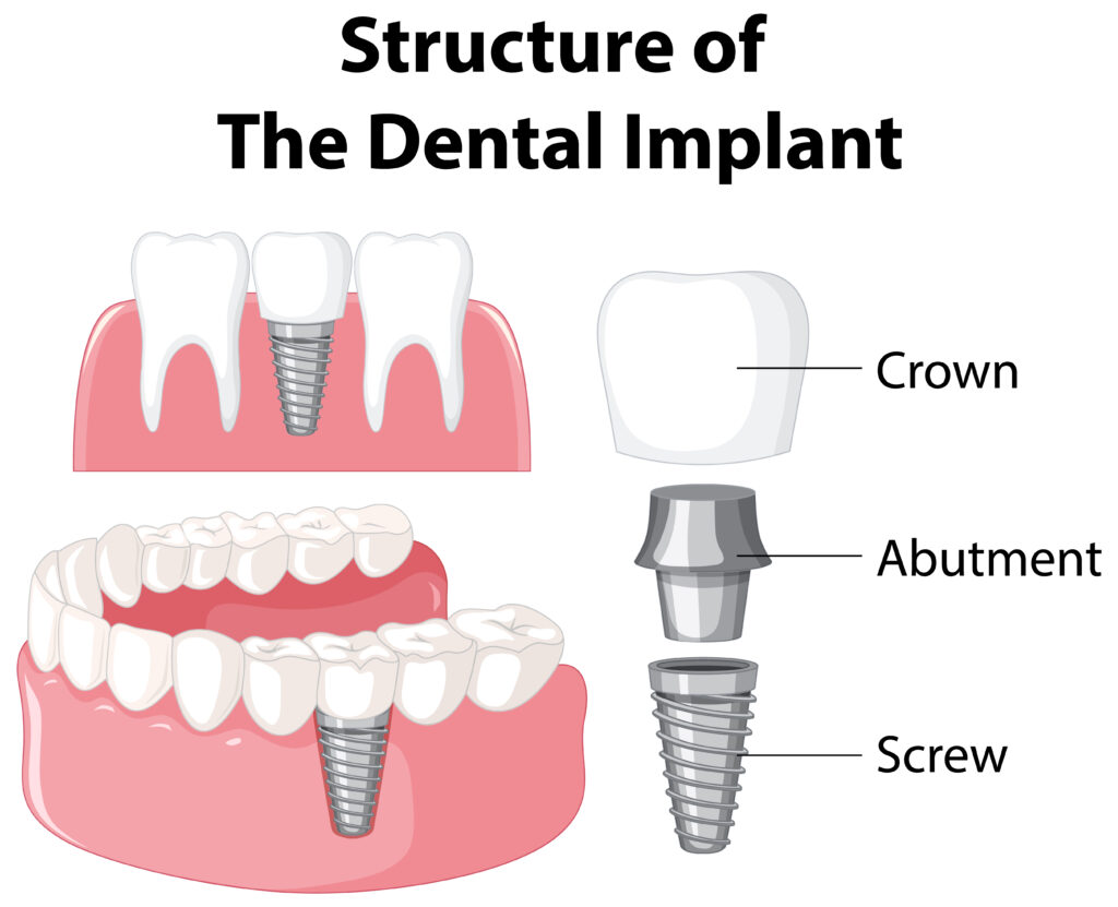 Dental Implants