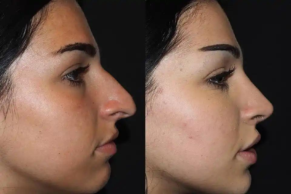 How to Choose the Best Rhinoplasty Surgeons in Dubai: Key Factors to Consider