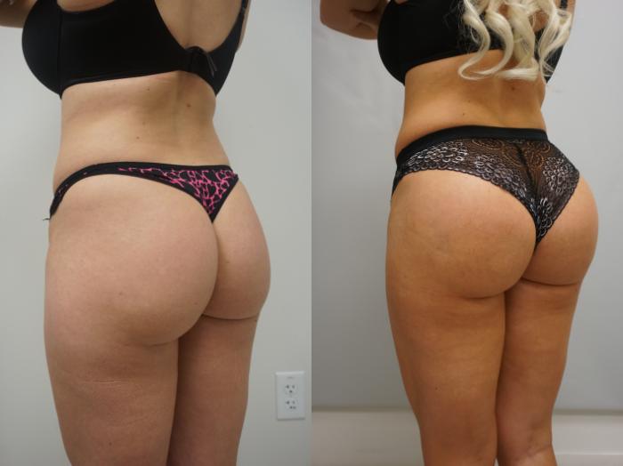 Brazilian Butt Lift NY