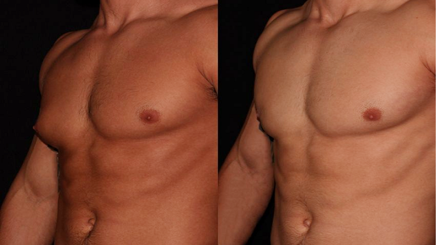 gynecomastia surgery dubai