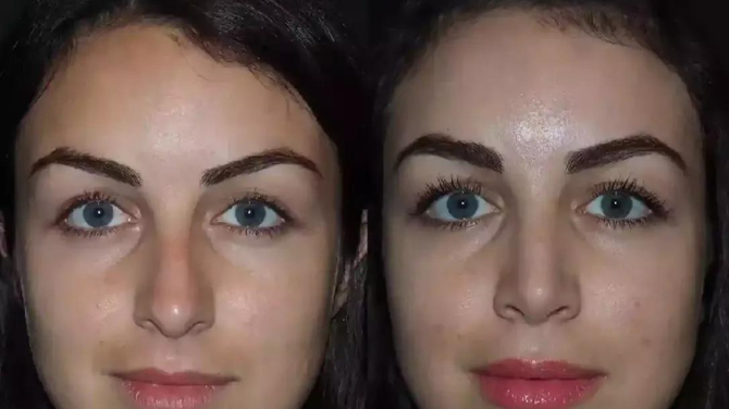 How the Best Rhinoplasty Surgeons in Dubai Deliver Natural-Looking Results