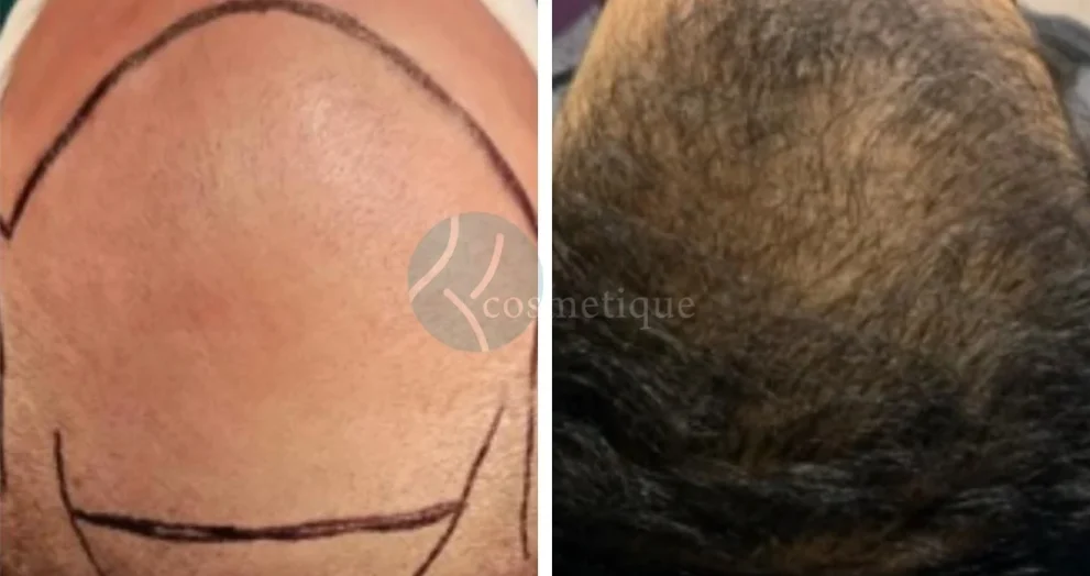 best hair transplant in lahore