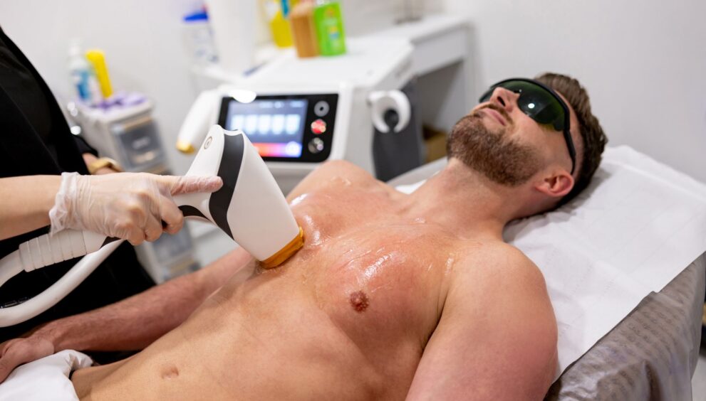 laser-hair-removal