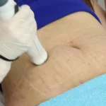 Laser stretch mark removal in London