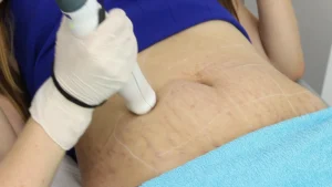Laser stretch mark removal in London